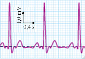 ECG