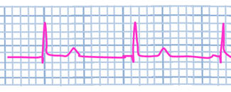 ECG