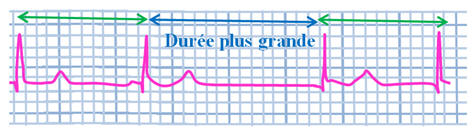 ECG