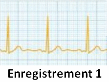 ECG