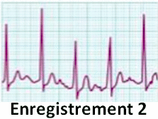 ECG
