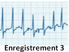 ECG